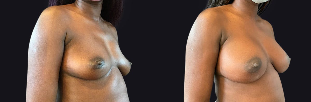 Breast Augmentation Before & After Gallery - Patient 177905895 - Image 2