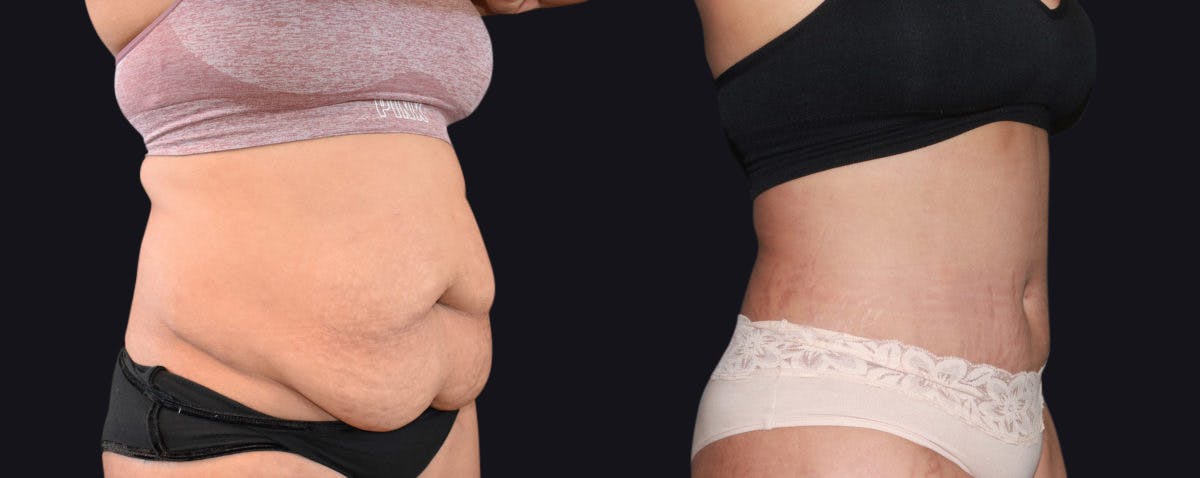 Abdominoplasty Before & After Gallery - Patient 177905896 - Image 2