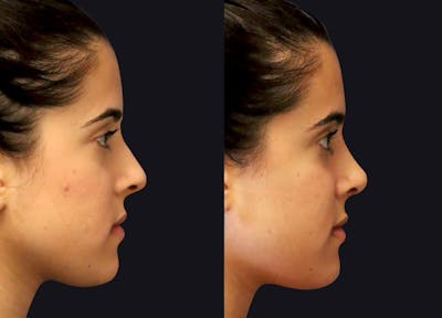 Rhinoplasty Before & After Gallery - Patient 195270 - Image 1