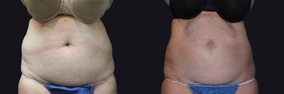 Coolsculpting Before & After Gallery - Patient 177905893 - Image 1