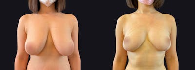 Breast Lift Before & After Gallery - Patient 177905898 - Image 1