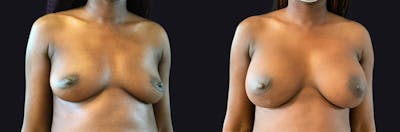 Breast Augmentation Before & After Gallery - Patient 177905895 - Image 1