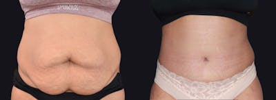 Abdominoplasty Before & After Gallery - Patient 177905896 - Image 1