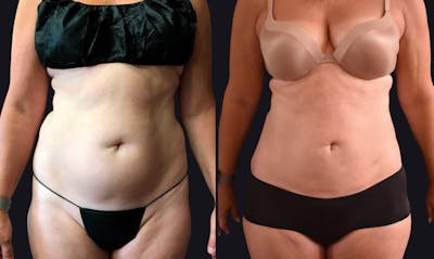 Liposuction Before & After Gallery - Patient 177905897 - Image 1