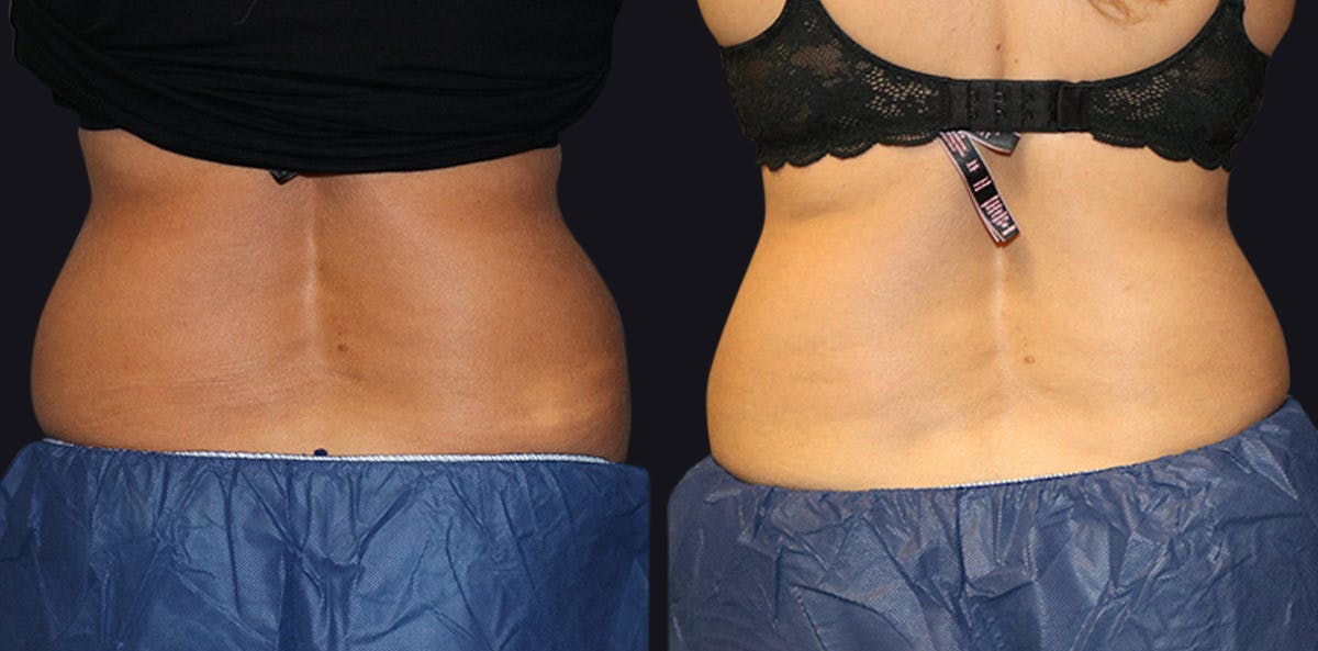 Coolsculpting Before & After Gallery - Patient 177905892 - Image 3