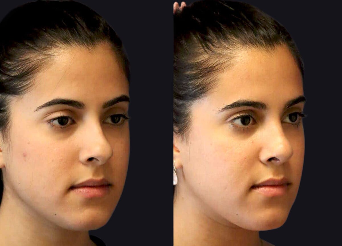 Rhinoplasty Before & After Gallery - Patient 195270 - Image 3