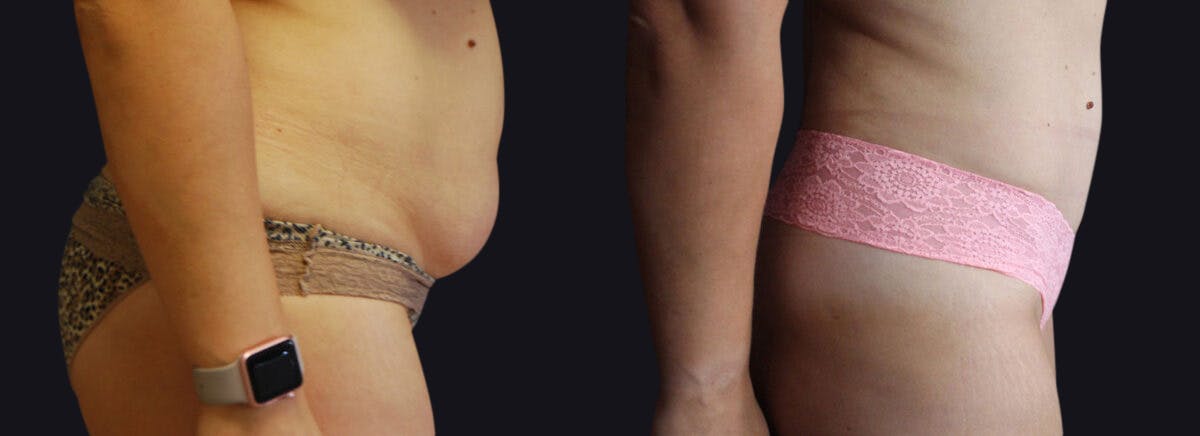 Abdominoplasty Before & After Gallery - Patient 177905890 - Image 3