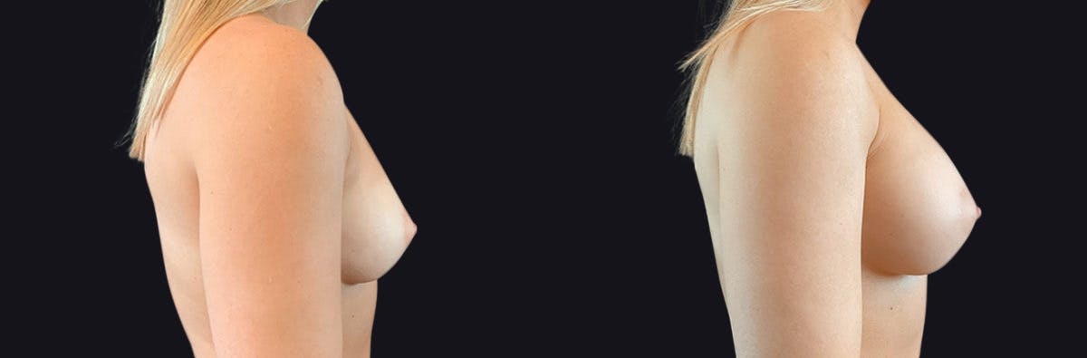 Breast Augmentation Before & After Gallery - Patient 177905889 - Image 3