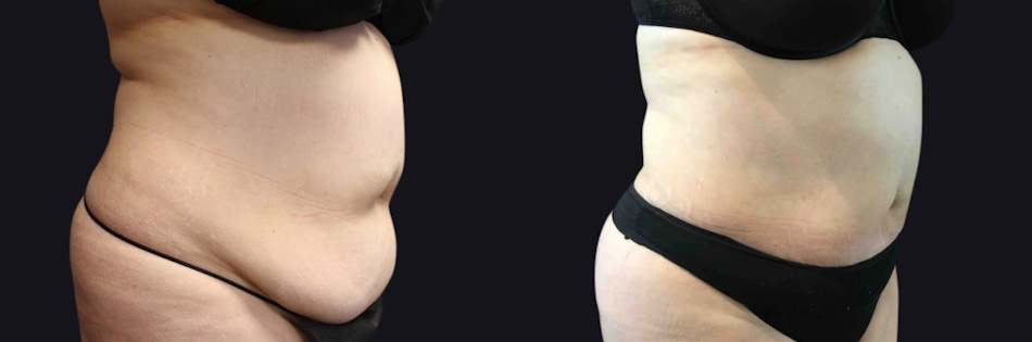 Liposuction and Fat Transfer Before & After Gallery - Patient 177905887 - Image 3