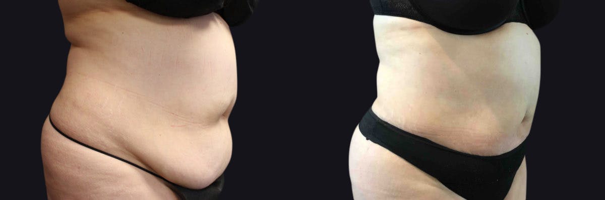 Liposuction Before & After Gallery - Patient 177905887 - Image 3