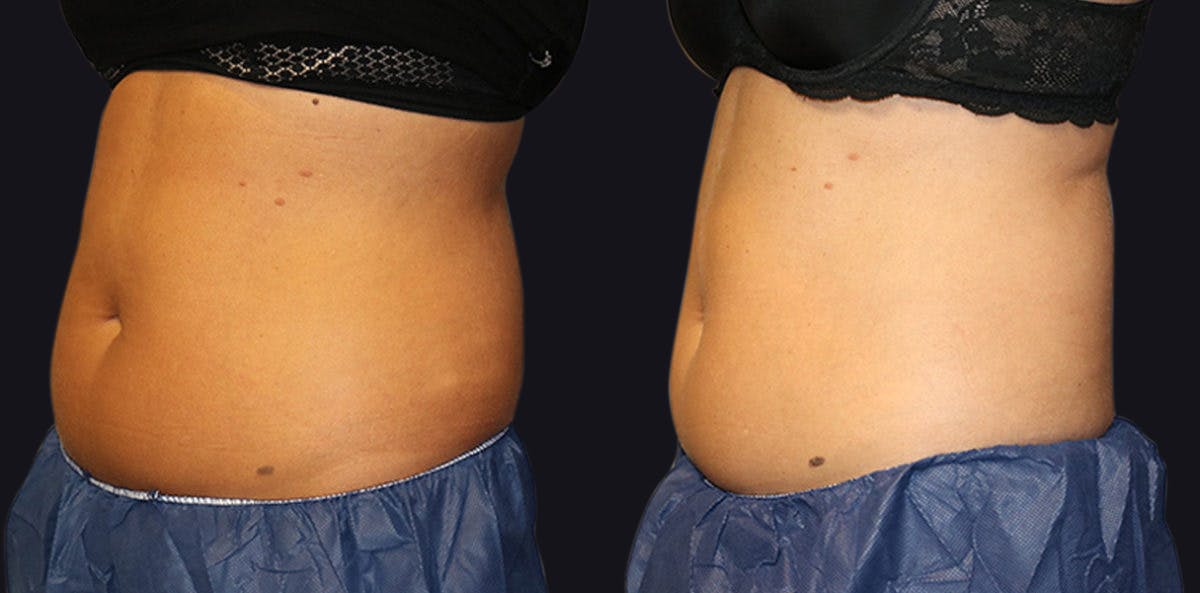Coolsculpting Before & After Gallery - Patient 177905892 - Image 2