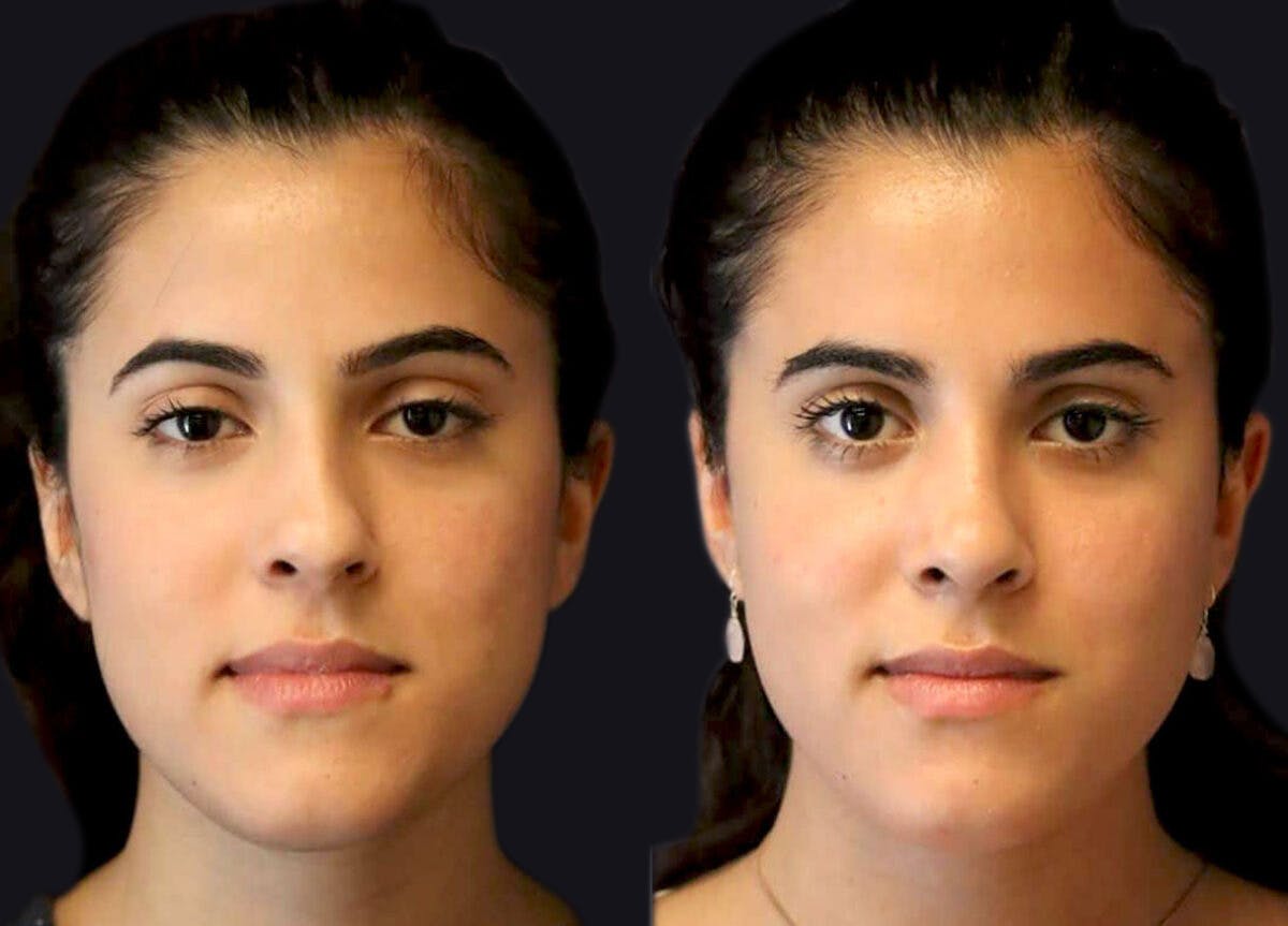 Rhinoplasty Before & After Gallery - Patient 195270 - Image 2