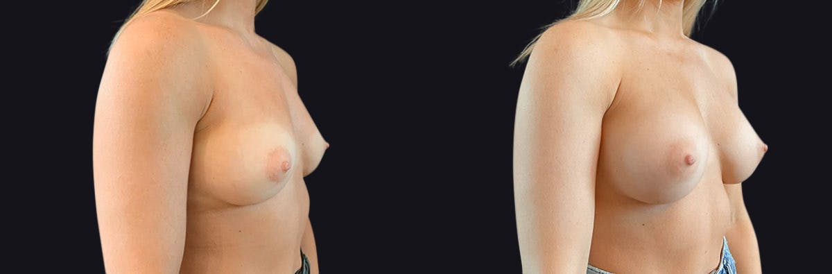 Breast Augmentation Before & After Gallery - Patient 177905889 - Image 2