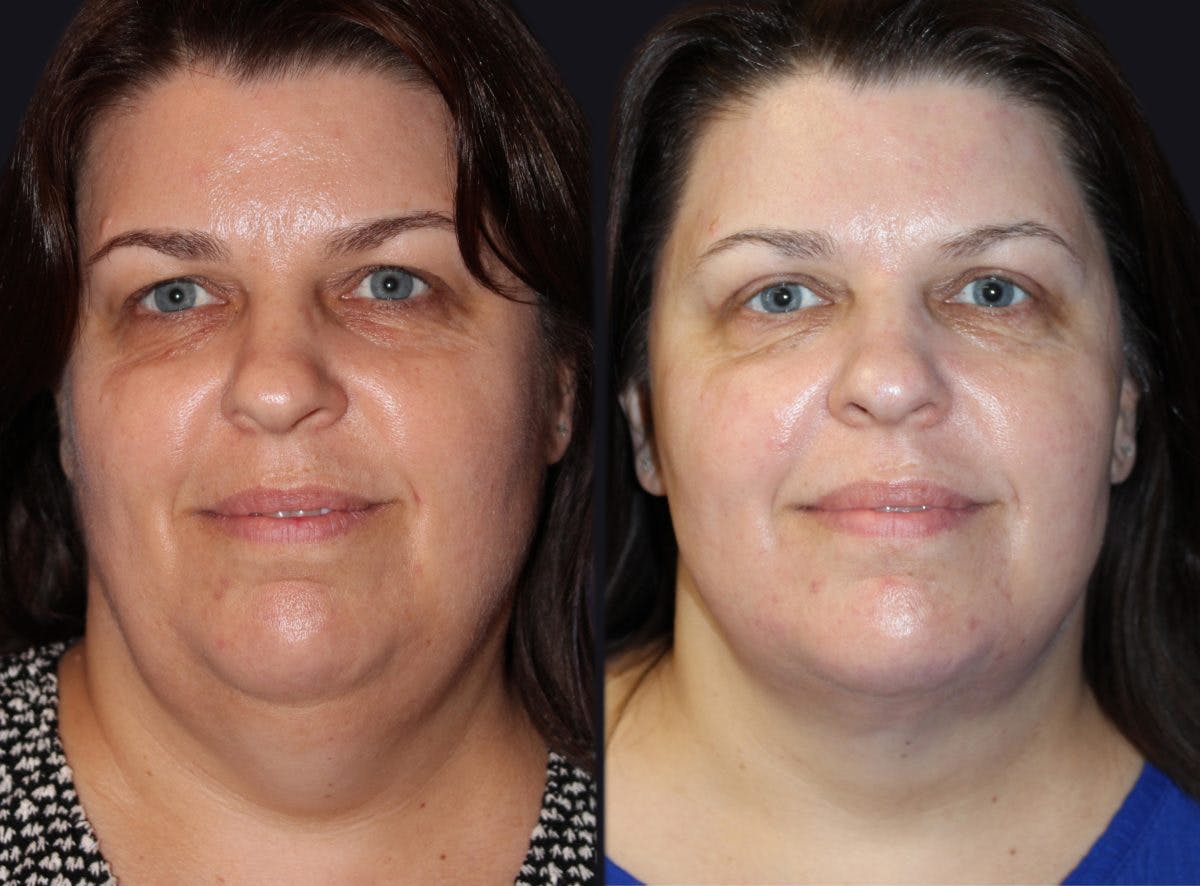 Neck Liposuction Before & After Gallery - Patient 177905886 - Image 2