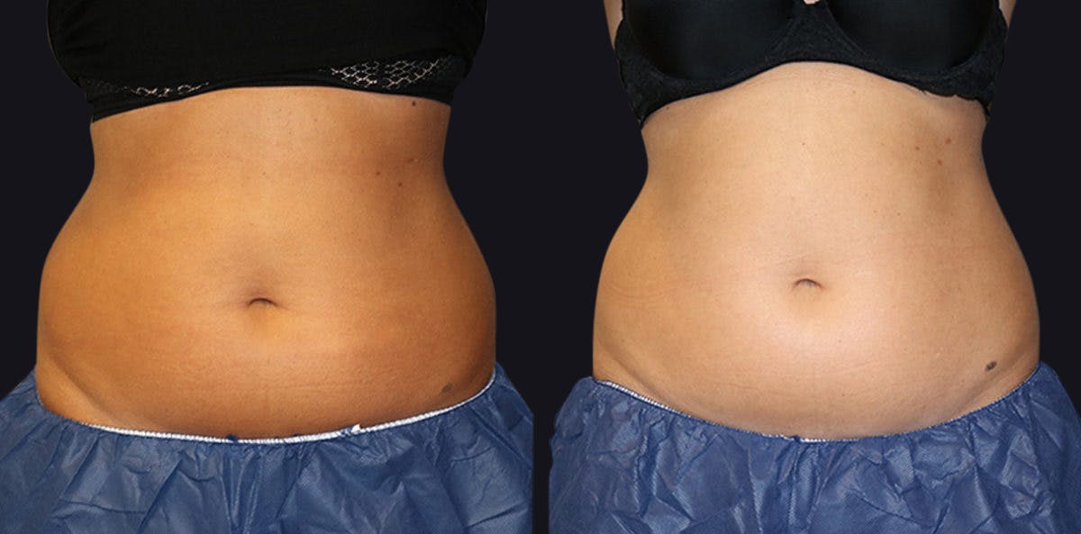 Coolsculpting Before & After Gallery - Patient 177905892 - Image 1