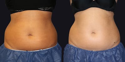 Coolsculpting Before & After Gallery - Patient 177905892 - Image 1