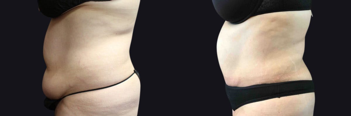 Liposuction Before & After Gallery - Patient 177905887 - Image 2