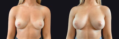 Breast Augmentation Before & After Gallery - Patient 177905889 - Image 1