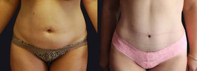 Abdominoplasty Before & After Gallery - Patient 177905890 - Image 1