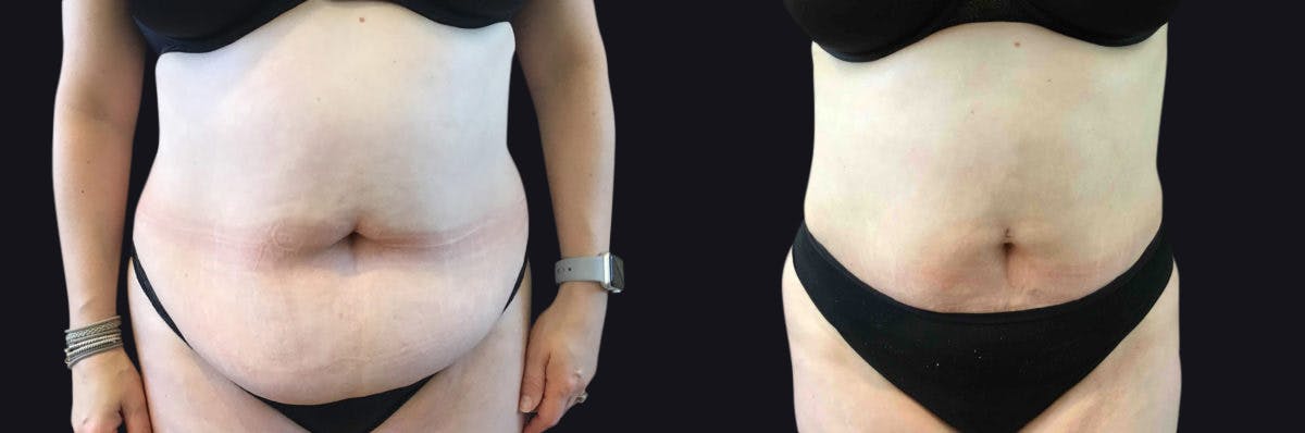 Liposuction Before & After Gallery - Patient 177905887 - Image 1