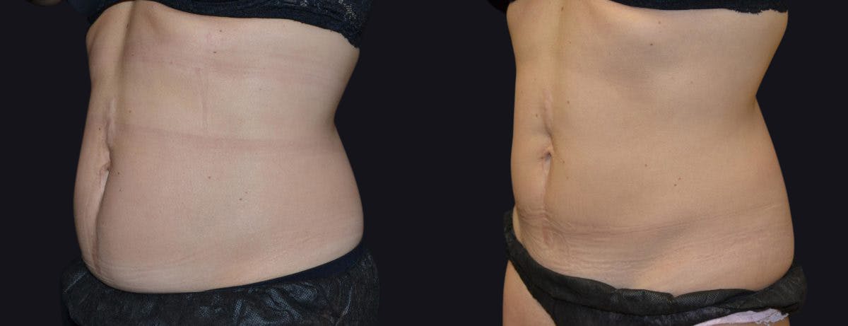Coolsculpting Before & After Gallery - Patient 177905884 - Image 2
