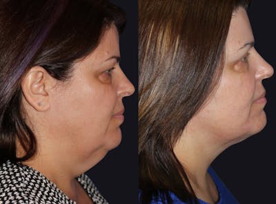 Neck Liposuction Before & After Gallery - Patient 177905886 - Image 1