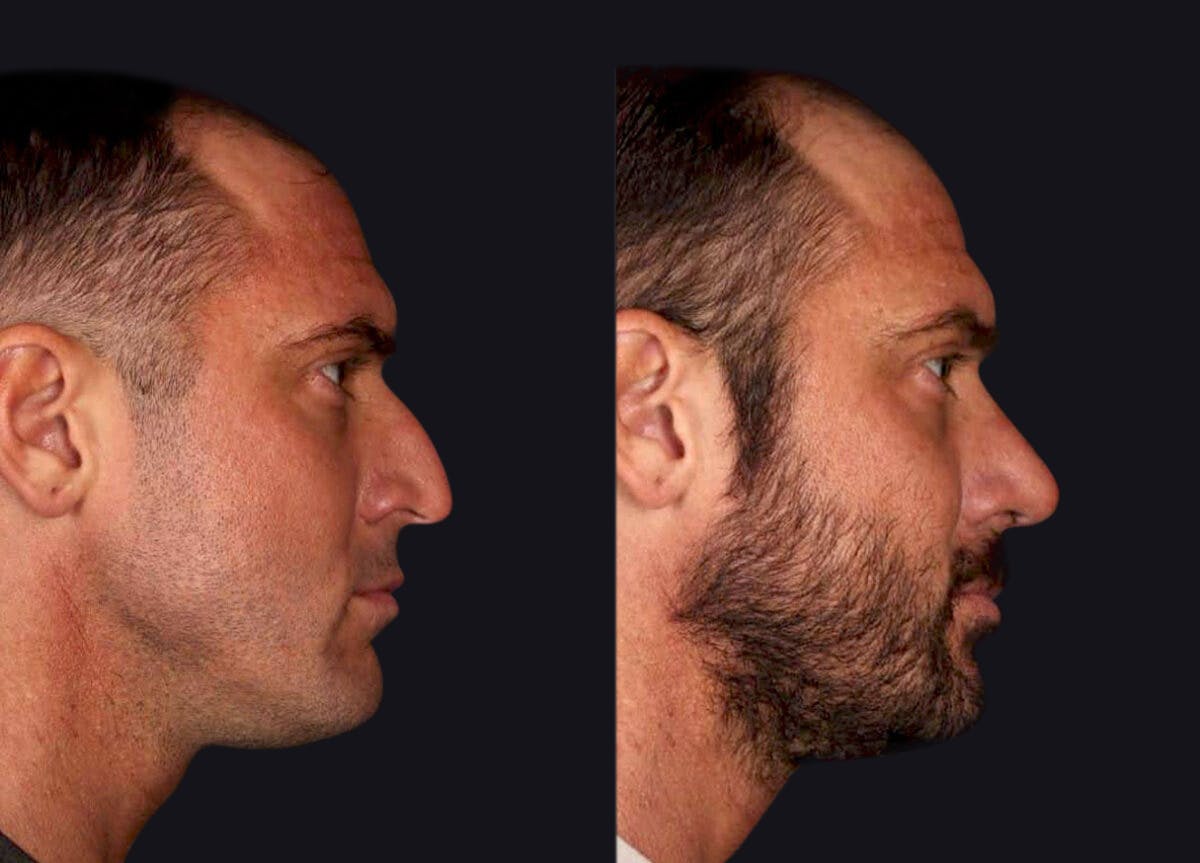 Rhinoplasty Before & After Gallery - Patient 177905885 - Image 4