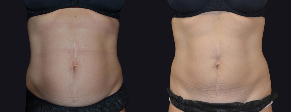 Coolsculpting Before & After Gallery - Patient 177905884 - Image 1