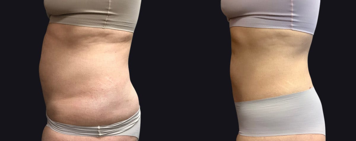 Liposuction Before & After Gallery - Patient 177905882 - Image 3