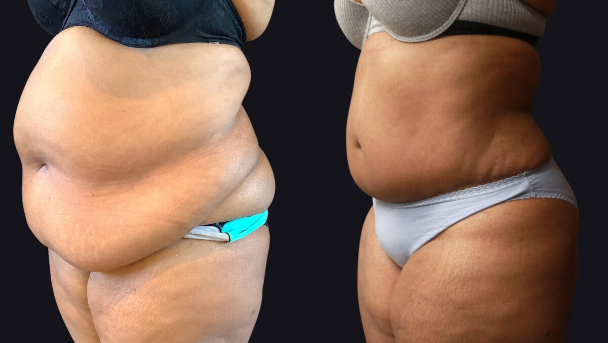 Abdominoplasty Before & After Gallery - Patient 177905883 - Image 3