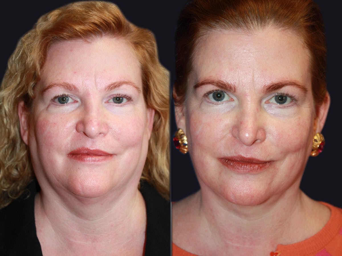 Neck Liposuction Before & After Gallery - Patient 177905879 - Image 2