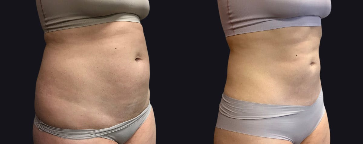 Liposuction Before & After Gallery - Patient 177905882 - Image 2