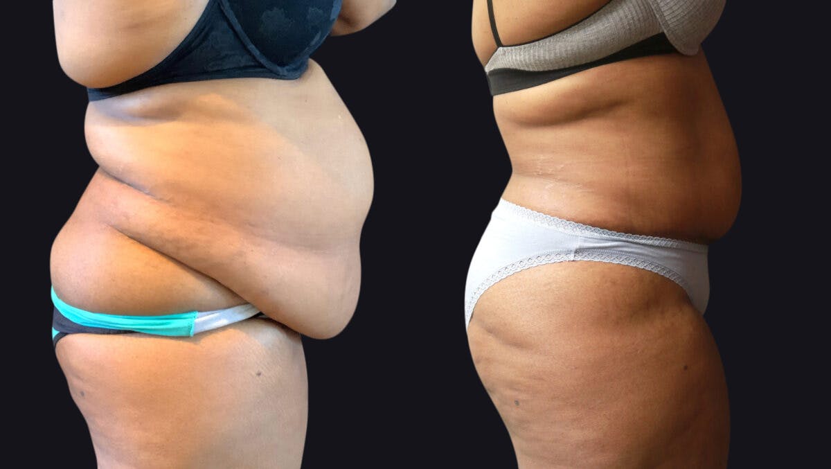 Abdominoplasty Before & After Gallery - Patient 177905883 - Image 2