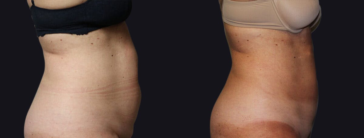 Coolsculpting Before & After Gallery - Patient 177905878 - Image 2