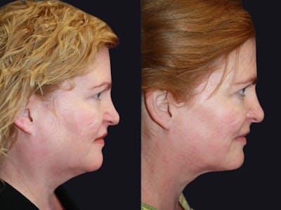 Neck Liposuction Before & After Gallery - Patient 177905879 - Image 1