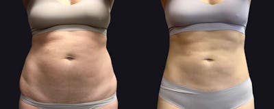 Liposuction Before & After Gallery - Patient 177905882 - Image 1