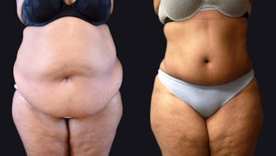 Abdominoplasty Before & After Gallery - Patient 177905883 - Image 1