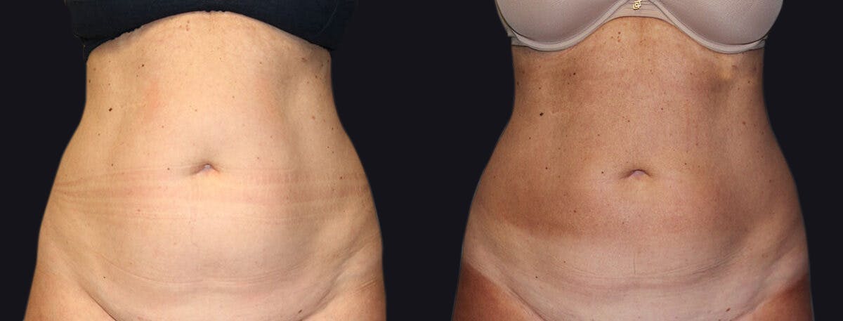 Coolsculpting Before & After Gallery - Patient 177905878 - Image 1