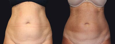 Coolsculpting Before & After Gallery - Patient 177905878 - Image 1