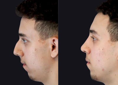 Rhinoplasty Before & After Gallery - Patient 177905872 - Image 1