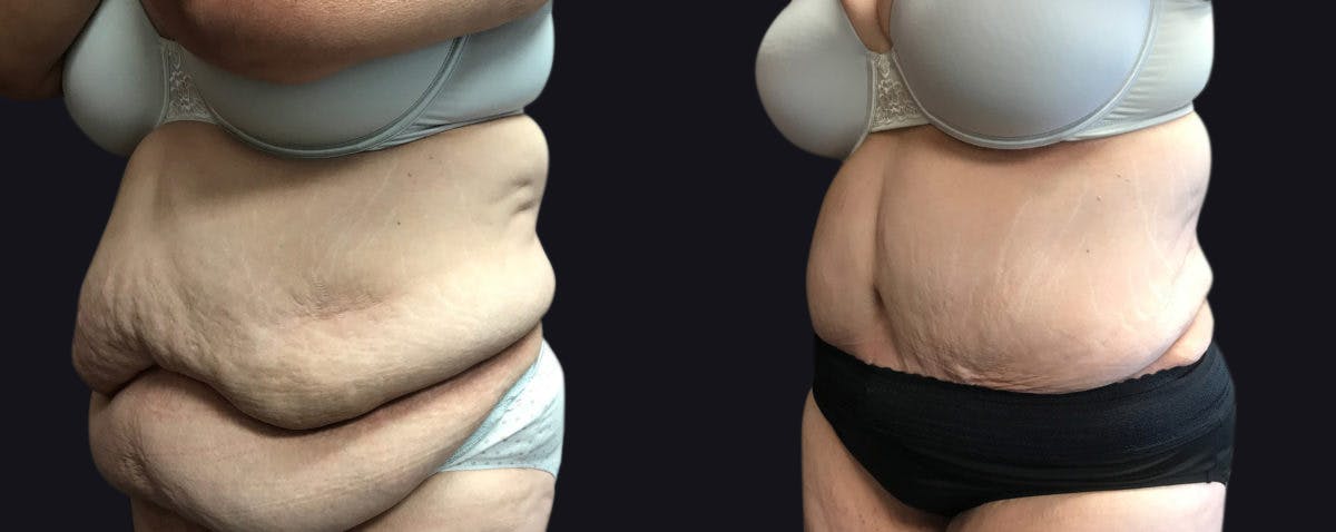 Abdominoplasty Before & After Gallery - Patient 177905869 - Image 3