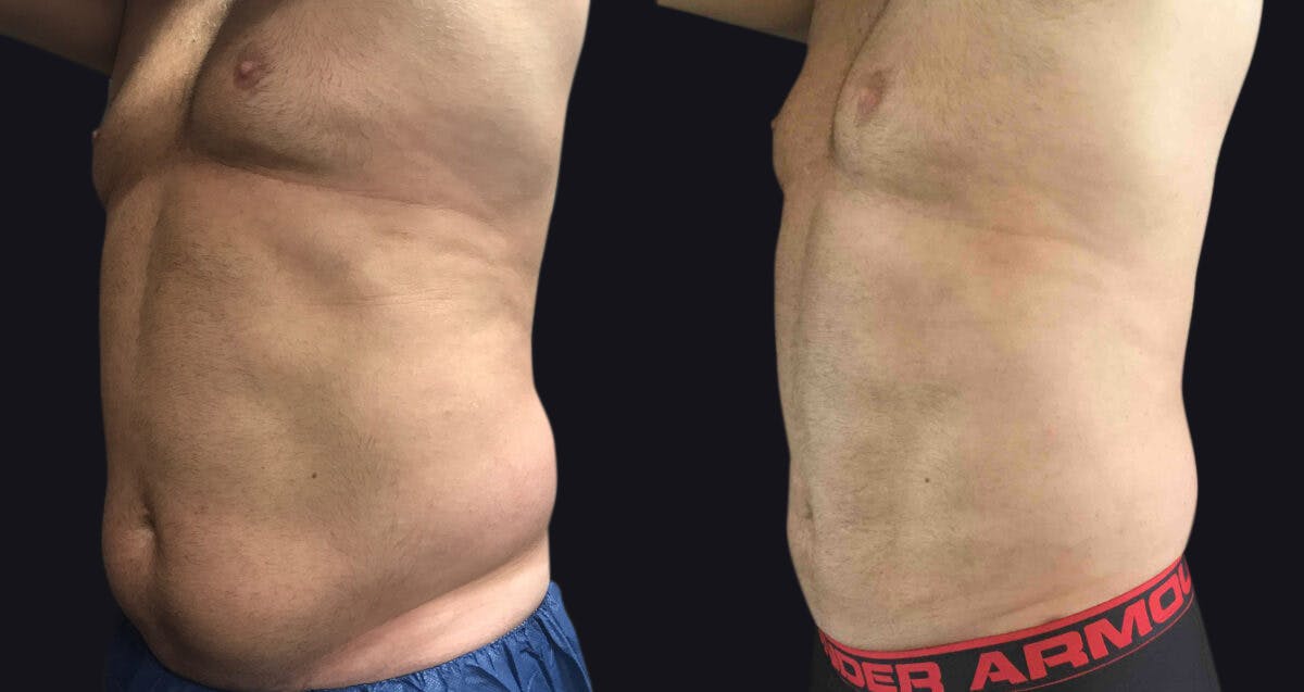 Liposuction Before & After Gallery - Patient 177905868 - Image 3
