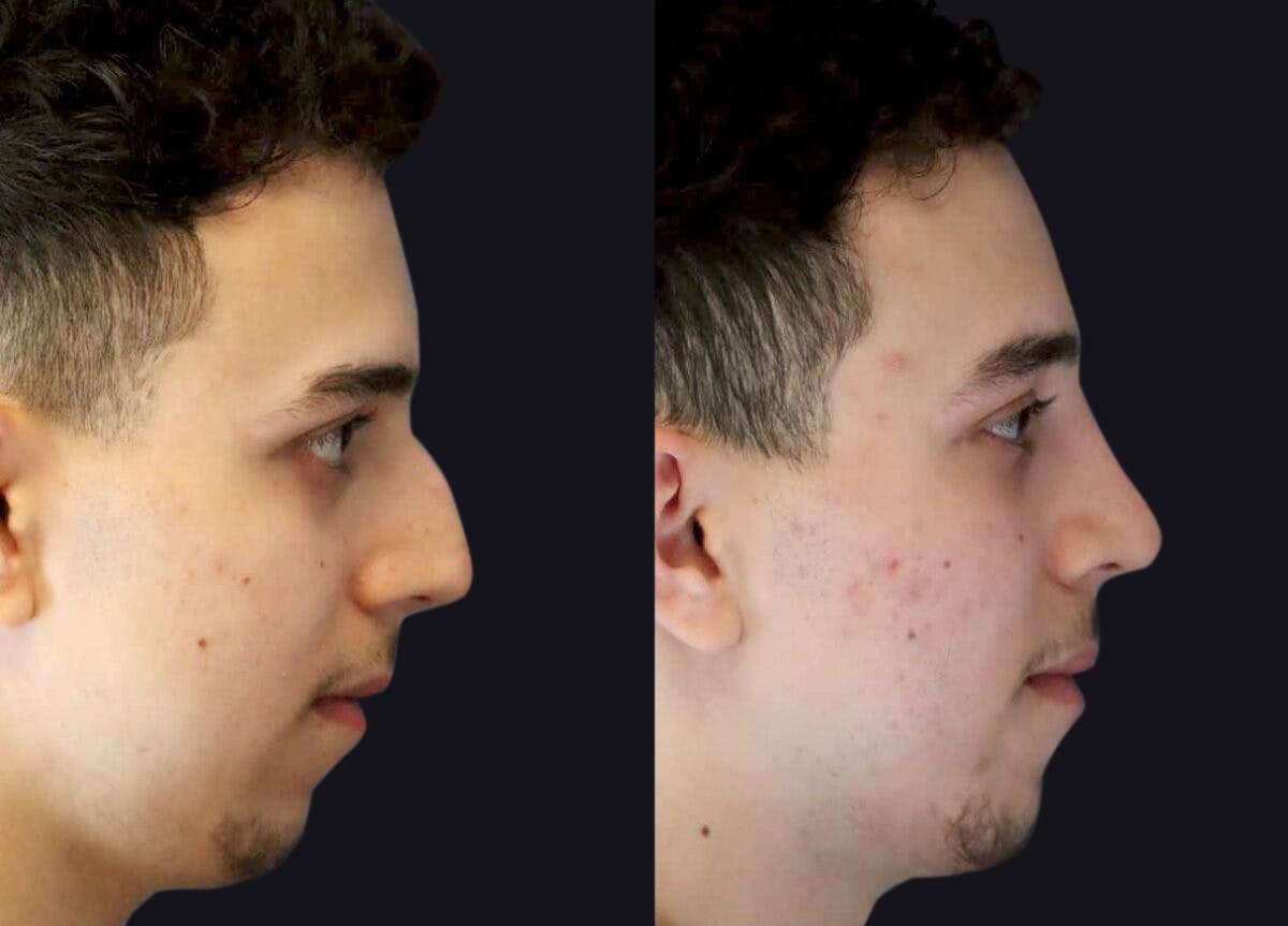Rhinoplasty Before & After Gallery - Patient 177905872 - Image 4