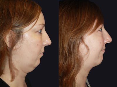 Neck Liposuction Before & After Gallery - Patient 177905871 - Image 1