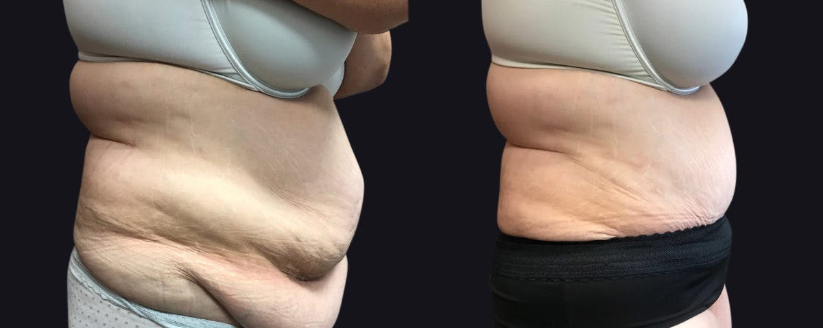 Abdominoplasty Before & After Gallery - Patient 177905869 - Image 2