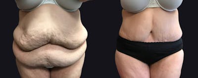 Abdominoplasty Before & After Gallery - Patient 177905869 - Image 1