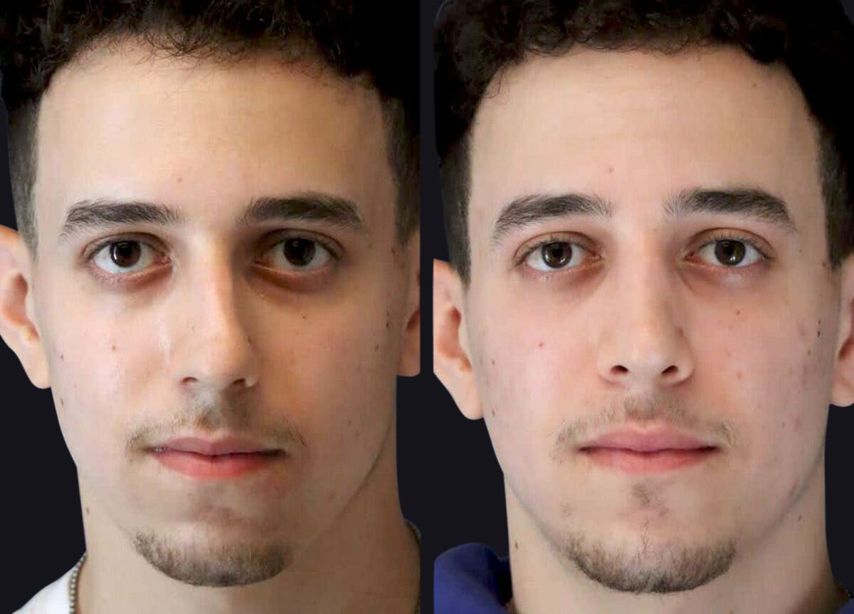 Rhinoplasty Before & After Gallery - Patient 177905872 - Image 2