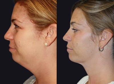 Neck Liposuction Before & After Gallery - Patient 177905866 - Image 1