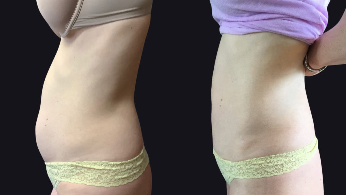 Abdominoplasty (Tummy Tuck) Before & After Gallery - Patient 177905865 - Image 3