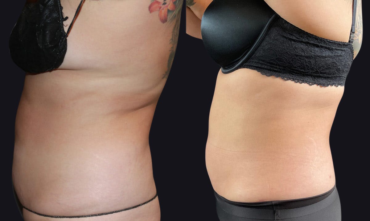 Liposuction Before & After Gallery - Patient 177905862 - Image 3